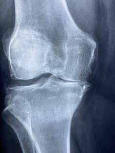 Read more about the article Osteoarthritis: A Brief Review of Integrative Treatment