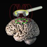 Transcranial Magnetic Stimulation for Depression