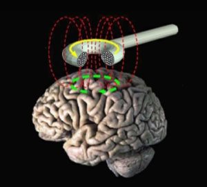 Read more about the article Transcranial Magnetic Stimulation for Depression